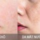 làn da khô