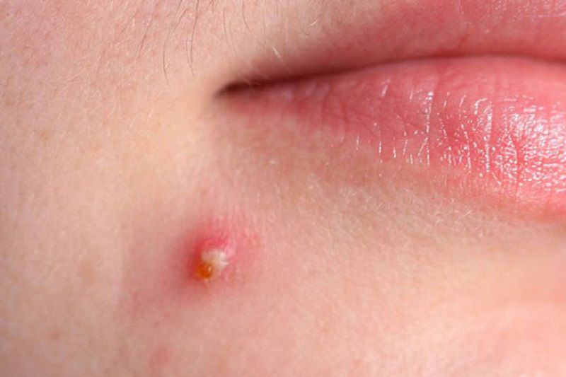 Những điều cần lưu ý khi chăm sóc mụn tại nhà