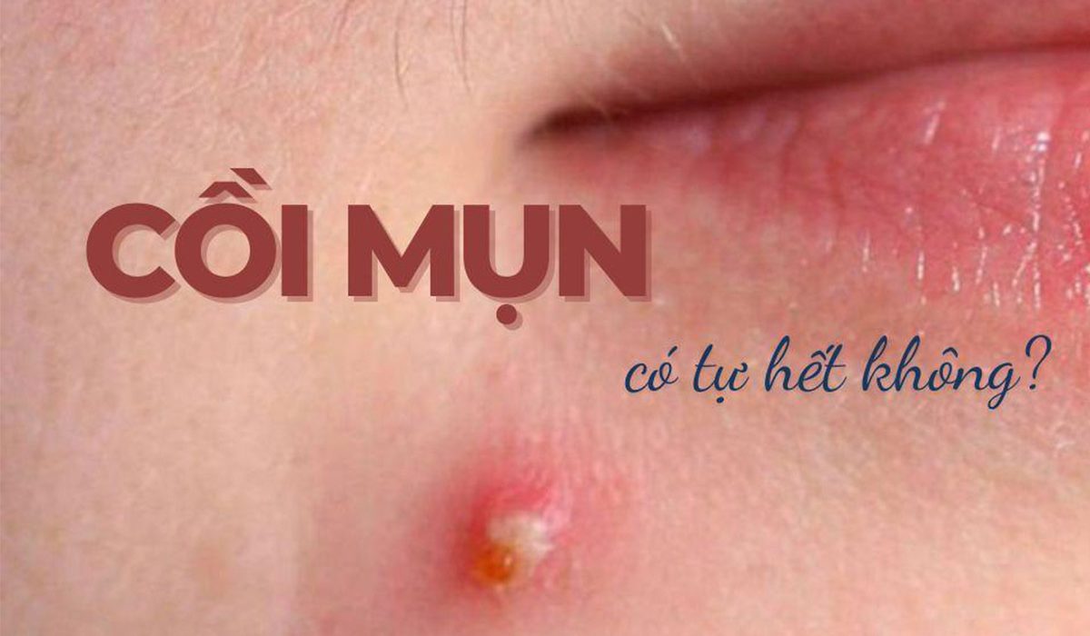 Cách giúp mụn gom cồi nhanh hơn và chăm sóc da đúng cách