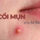 Cách giúp mụn gom cồi nhanh hơn và chăm sóc da đúng cách
