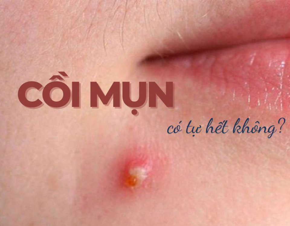 Cách giúp mụn gom cồi nhanh hơn và chăm sóc da đúng cách