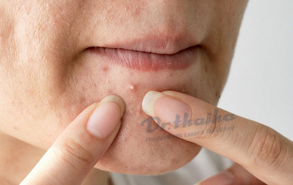 Mụn gom cồi mang lại lợi ích gì cho làn da