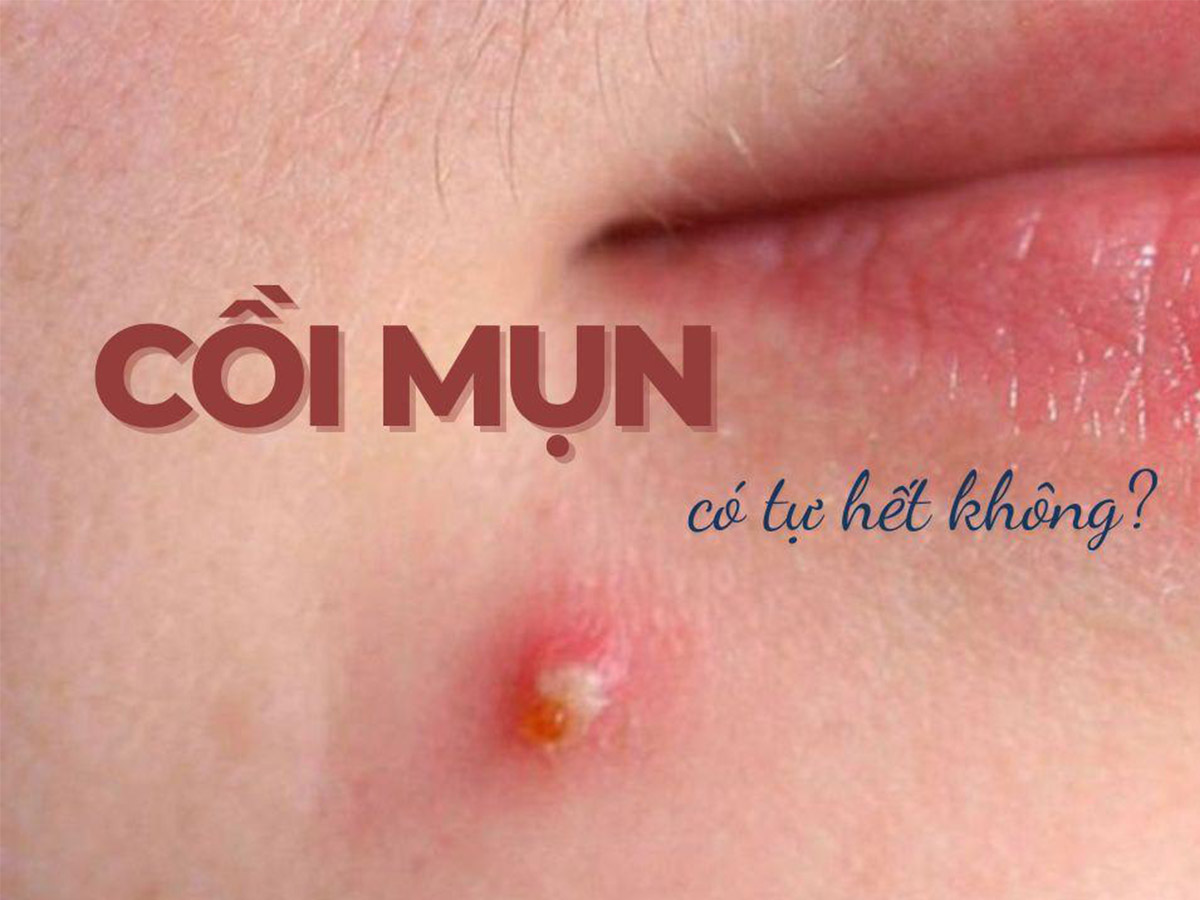 Cách giúp mụn gom cồi nhanh hơn và chăm sóc da đúng cách