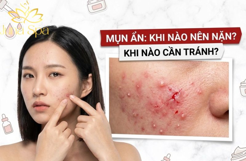 Khi nào nên lấy nhân mụn ẩn