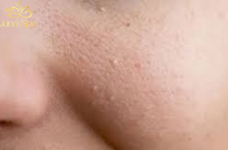 Những trường hợp không nên tự ý nặn mụn