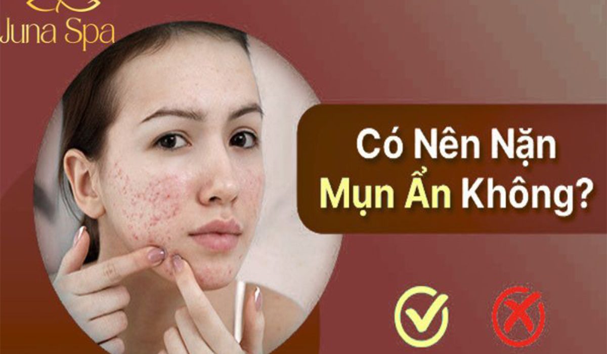 có nên nặn mụn ẩn không banner