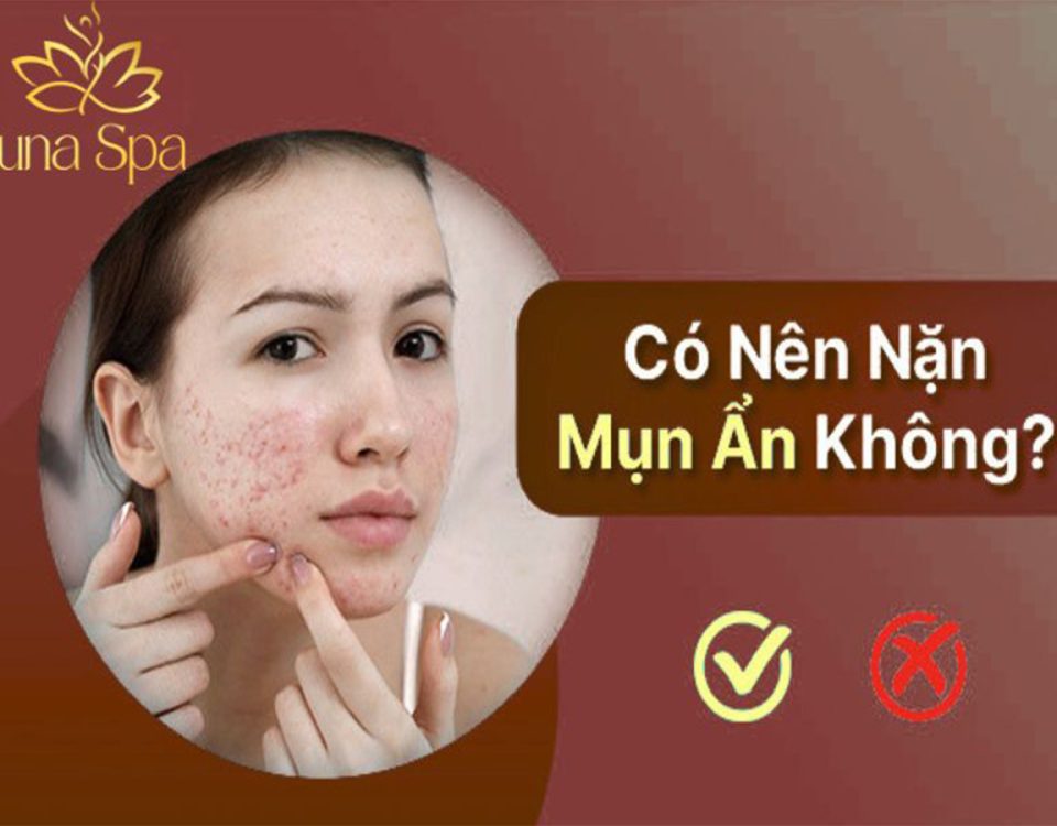 có nên nặn mụn ẩn không banner