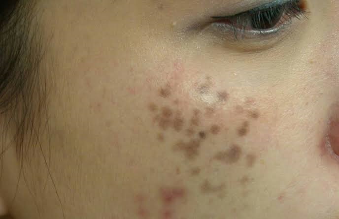 những điều cần biết nám chân sâu